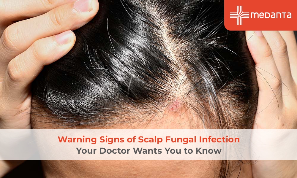 Ringworm of the Scalp